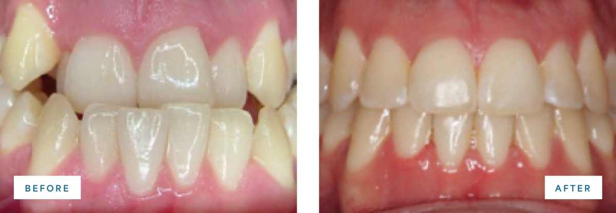 before and after photo