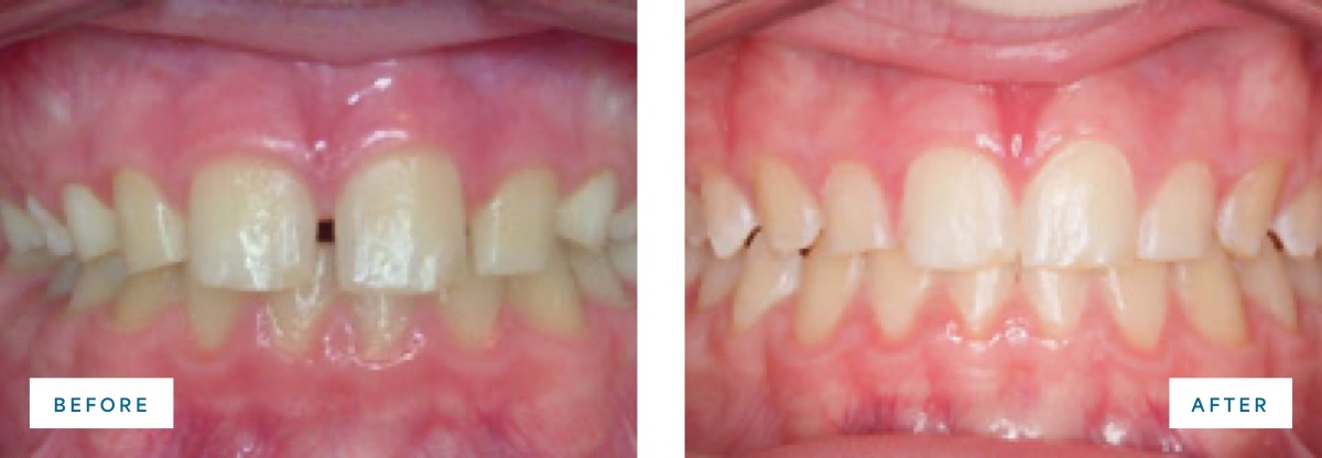 before and after photo